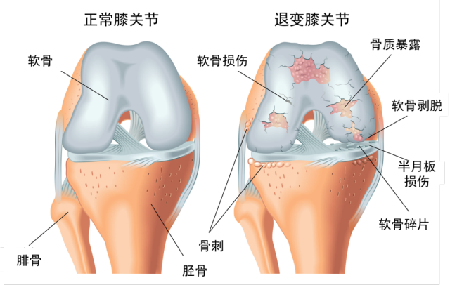 同样,缺乏运动的软骨也会因为失去正常代谢而发生退变.