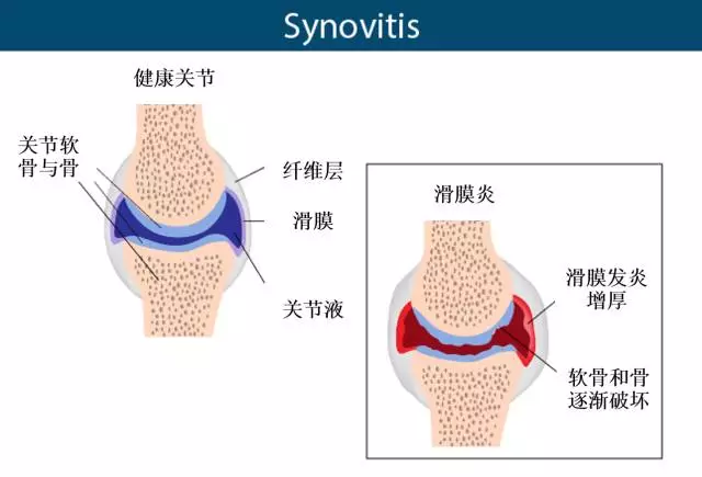 膝关节滑膜炎是以膝关节肿胀,疼痛,积液,功能受限等为主要症状的非